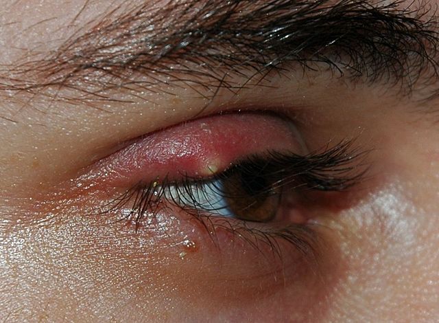 File:Stye02.jpg