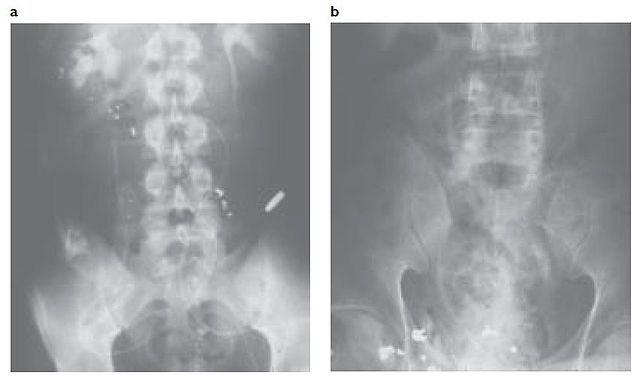 File:AK-47 gunshot wound to abdomen in Vietnam.jpg