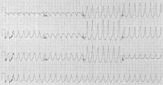 File:Electrocardiogram of Ventricular Tachycardia.png