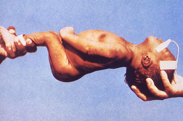 File:Neonatal tetanus 6374.jpg