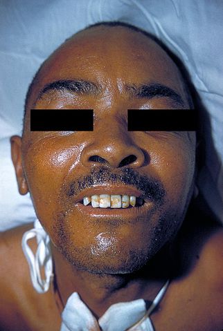 File:Lock-jaw 2857.jpg