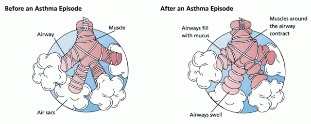 File:Asthma before-after.png