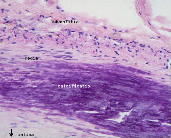 File:Calcificatio atherosclerotica.jpg